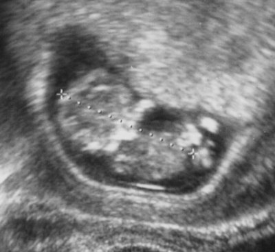 [Ultra sound image]